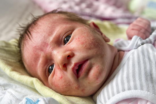 Neugeborenen Akne - Baby Akne