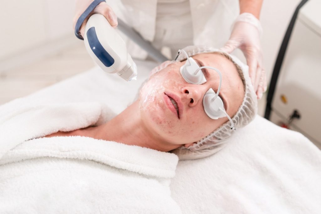 Lasertherapie bei Akne
